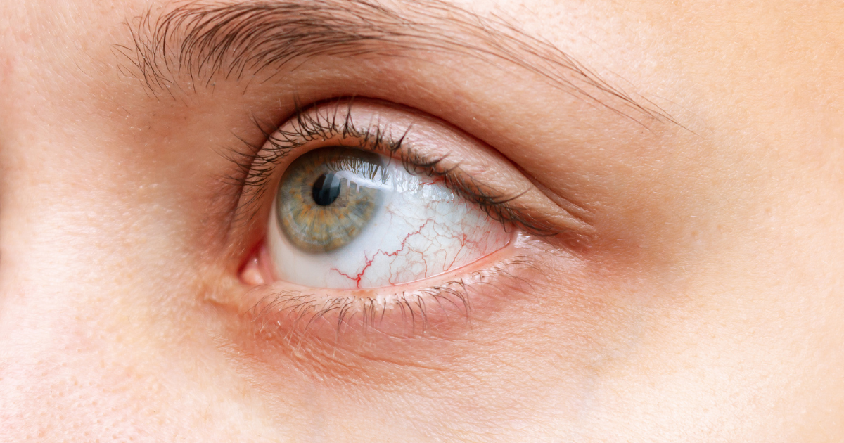 Juvenile Arthritis and Uveitis: Why Eye Screening Is So Important